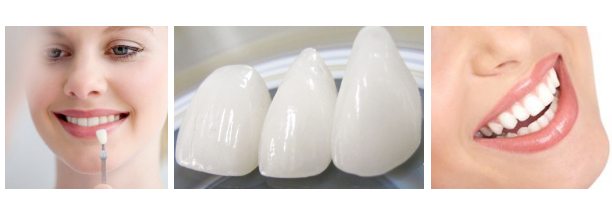 Porcelain-Veneers-Lumineers
