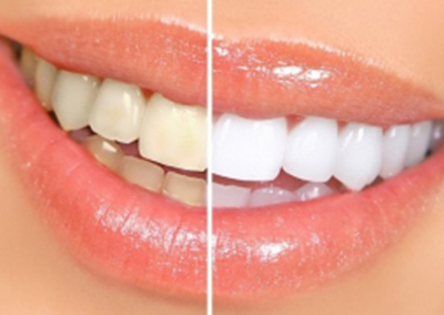 Estetică dentară – Albire dentară