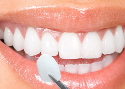 Estetică Dentară – Fațete dentare ceramice